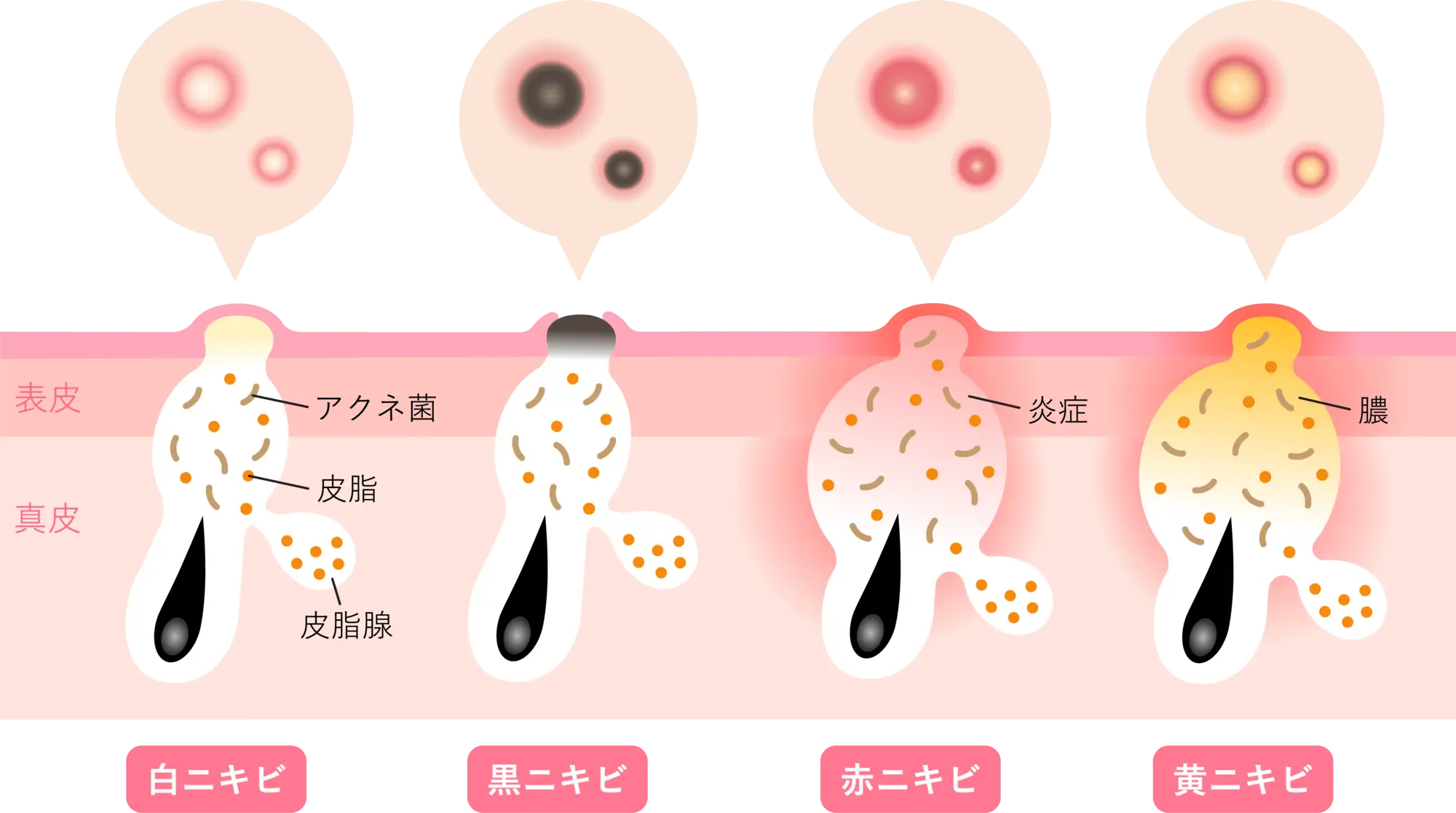 うるおいクリニック思春期ニキビの種類と特徴